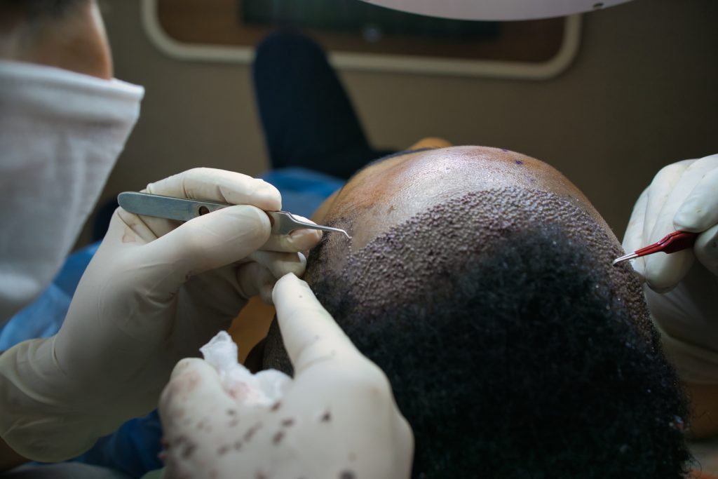 how much is hair transplant in turkey